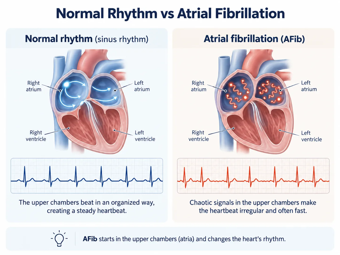 In normal rhythm, one signal starts at the top of the right atrium and spreads in an organized way, so the heartbeat is steady. In AFib, chaotic signals fire all over both upper chambers, so the heartbeat becomes irregular and often fast.